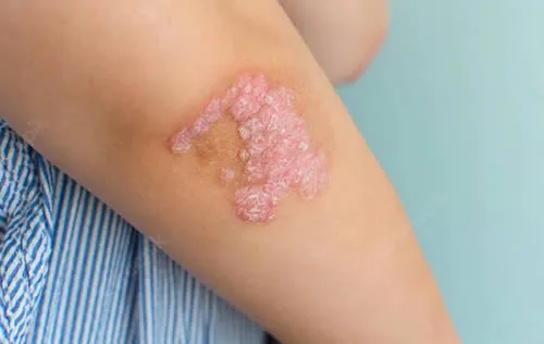 psoriasis on arm