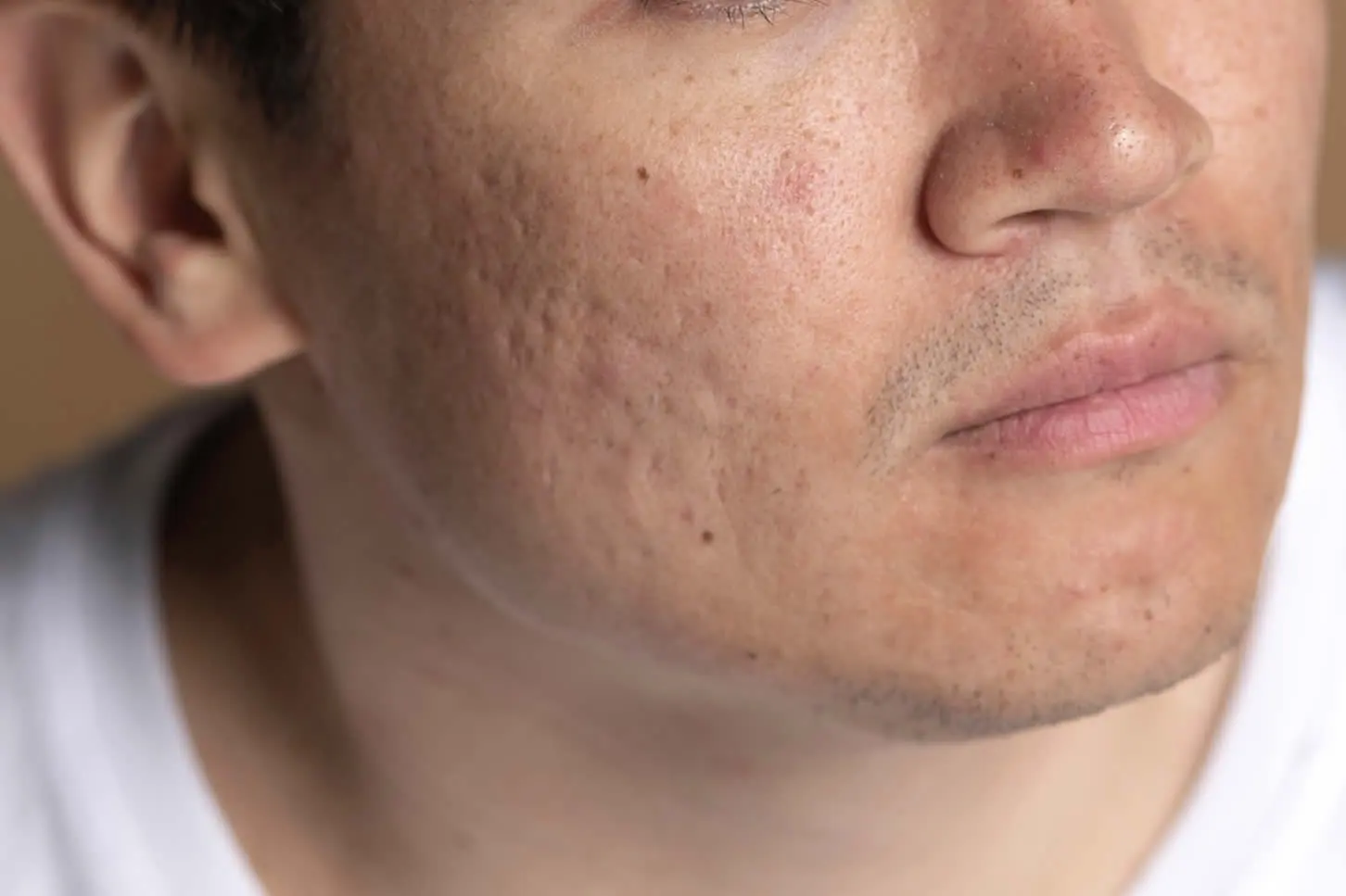 acne scars on face