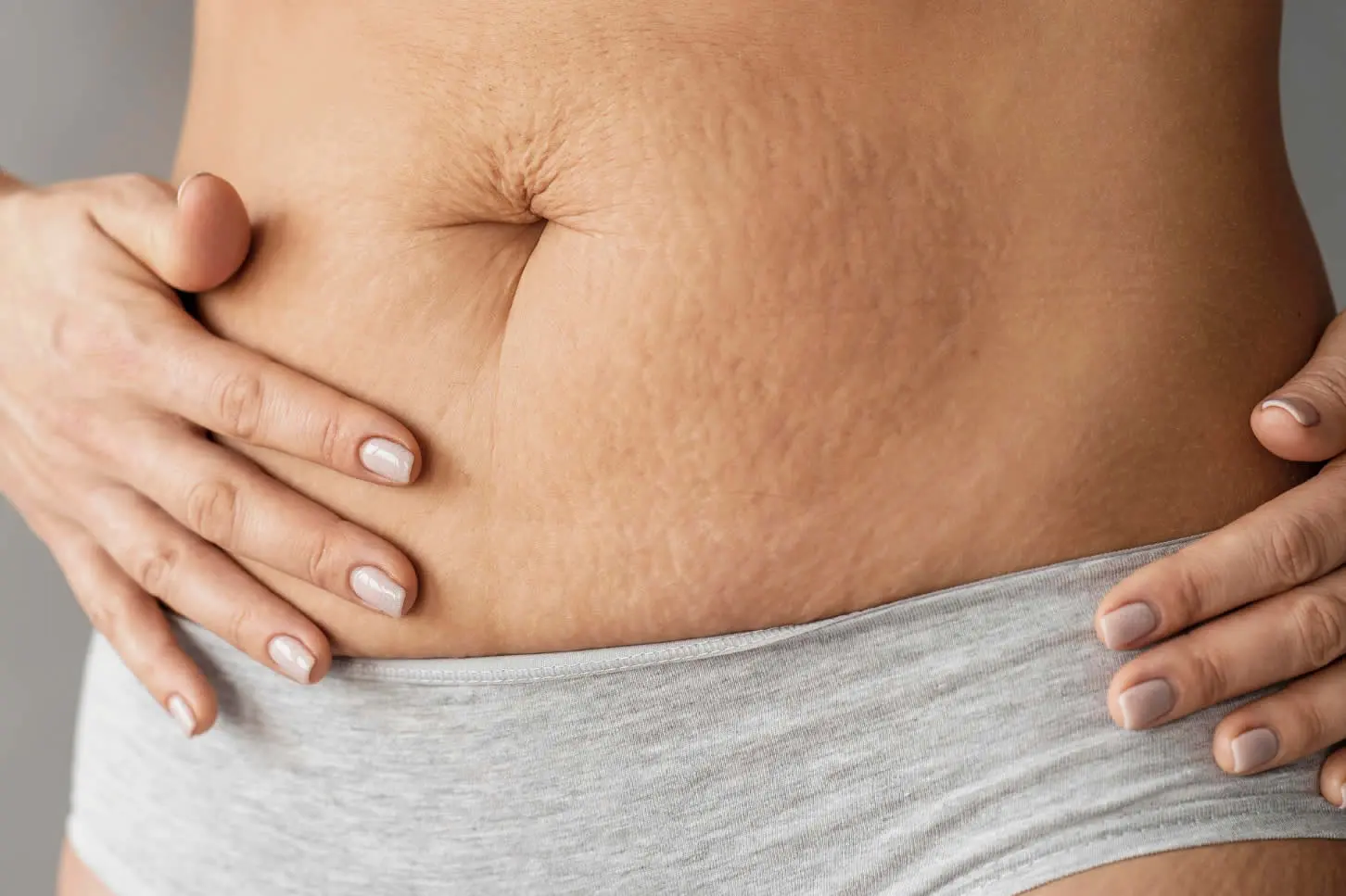 close-up-woman-with-stretch-marks