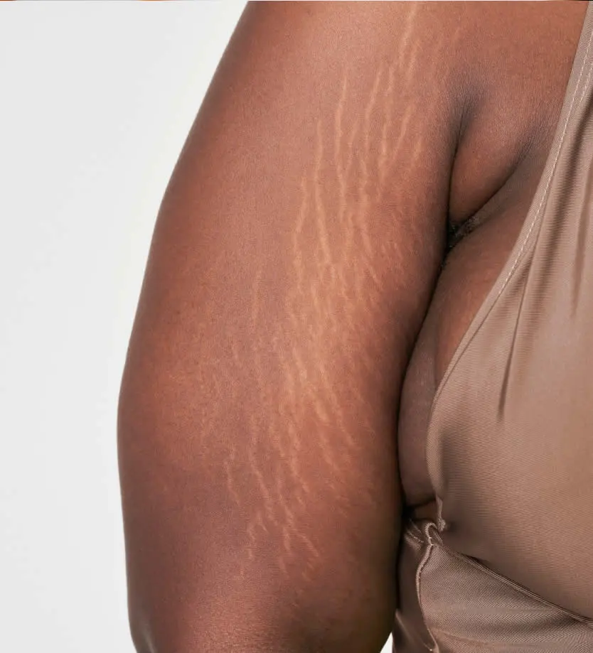 plus-size-woman-arm-s-white-stretch-mark-body-positivity-shoot